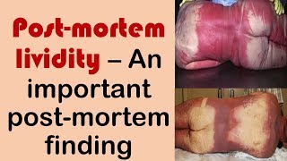 Postmortem lividity  An important postmortem change [upl. by Nimoynib]