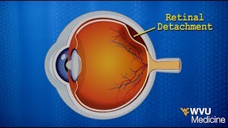 Detached Retina after Cataract Surgery [upl. by Adahsar]