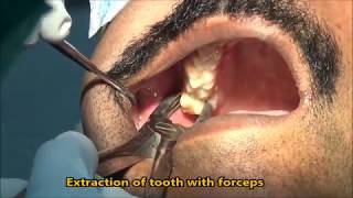 Upper wisdom tooth extraction with forceps [upl. by White]