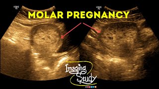 Molar Pregnancy  Hydatidiform Mole  Gestational Trophoblastic Disease  Ultrasound  Case 38 [upl. by Nwahsav]