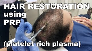 Scalp Hair Restoration using Platelet Rich Plasma  West End Plastic Surgery [upl. by Cassie]