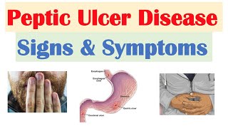 Pain of Duodenal Ulcer Improves on eating…Ever Wonder Why [upl. by Aynosal]