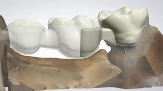 3Shape Dental System  Split Bridge Design [upl. by Kalbli]