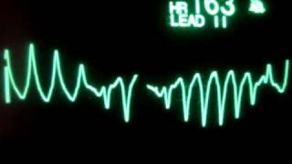 Ventricular Tachycardia Cardiac Arrhythmia 3D Animation [upl. by Ttevi853]