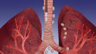 EBUS Procedure OverviewOlympus Bronchoscopy [upl. by Anaeli278]