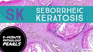 Seborrheic Keratosis 5Minute Pathology Pearls [upl. by Koy263]