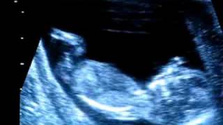 Sonogram 6 weeks pregnant [upl. by Erbma15]