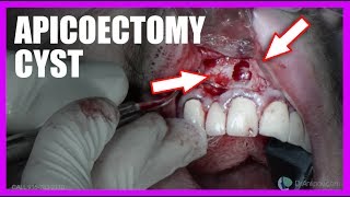 Apicoectomy Cyst SURGERY [upl. by Tnayrb]