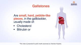 Gallstones  Cholelithiasis Symptoms Causes Diagnosis and Treatment [upl. by Gladdy]