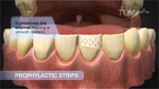 Prophylactic Strips TDV  Tartar Removal [upl. by Clein957]