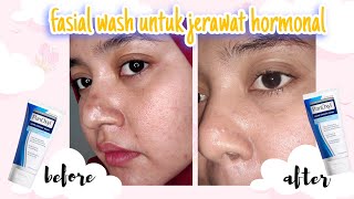 Review panoxyl acne foaming wash [upl. by Ulita]