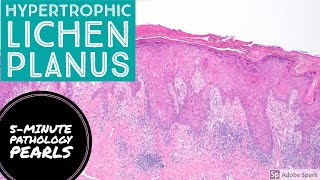 Hypertrophic Lichen Planus 5Minute Pathology Pearls [upl. by Scarlett]