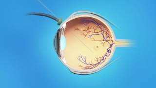 Macular Hole Vitrectomy Surgery [upl. by Eletnahc208]