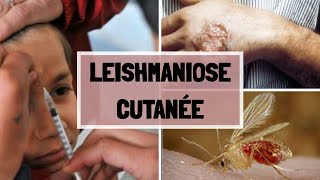 LA LEISHMANIOSE CUTANNÉ  CAUSES  SYPMTOMES  COMPLICATIONS  TRAITEMENT [upl. by Iong]