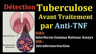 Dépistage de Tuberculose latent avant AntiTNF infection tuberculeuse pulmonaire IDR interféron Gamma [upl. by Juni861]