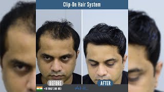 Clip on Hair Systems in India  Hair PatchesWigs for men [upl. by Artemahs]