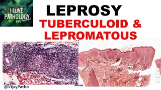 LEPROSY etiopathogenesis classification Tuberculoid amp lepromatous leprosy [upl. by Platas]