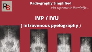 Bilateral nephrostomy and antegrade stents the easy way [upl. by Darryl769]