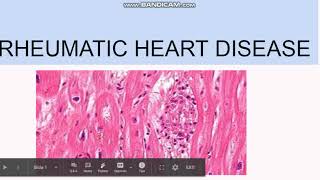 Rheumatic Heart Disease Pathogenesis Morphology Clinical features [upl. by Letsyrhc675]