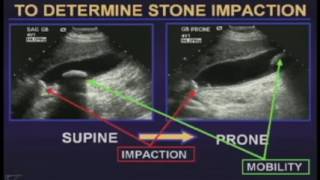 Ultrasound of the Gallbladder [upl. by Aicilic]