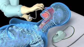 How to nasotracheal suction [upl. by Fern]