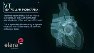 Hypertrophic cardiomyopathy HCM causes symptoms treatment amp pathology [upl. by Iblok92]