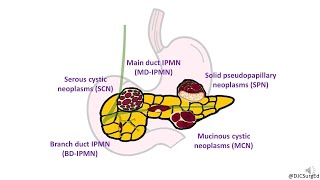 Neoplasia Nomenclature  Benign Tumors  Adenoma  Papilloma [upl. by Suisyola724]