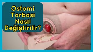 Stoma nedir  Ostomi Torbası Nasıl Değiştirilir [upl. by Ailic]