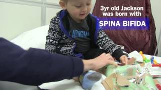 Spina Bifida [upl. by Pacificia]