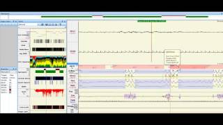 Sleep Study Data A closer look at sleep apnea [upl. by Adiarf217]