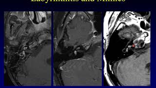 Temporal Bone Pathology 6 Hearing Loss Part 1 [upl. by Ardried680]