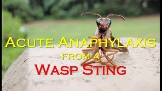 Acute Anaphylaxis from a Wasp Sting [upl. by Donelle]