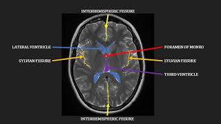 Introduction to MRI of the brain [upl. by Breeze914]