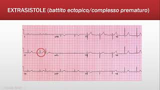 What is atrial fibrillation [upl. by Consalve302]