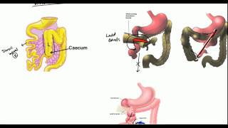 Gut Malrotation Nonrotation and Volvulus for USMLE [upl. by Agiaf374]