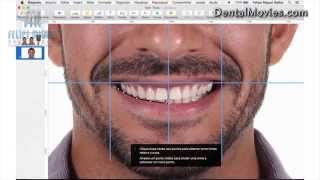 DSD  Digital Smile Design by Felipe Miguel [upl. by Eelnayr177]