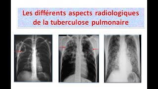 interprétation des clichés thoraciques tuberculosepulmonaire partie 1 [upl. by Yreved549]