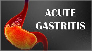 GASTROESOPHAGEAL REFLUX DISEASE GERD Causes SIgns and Symptoms Diagnosis and Treatment [upl. by Miller948]