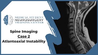 Spine Imaging Case 2 Atlantoaxial Instability [upl. by Messab211]