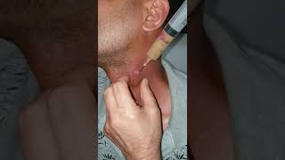 abcès dorigine tuberculeuse [upl. by Forras]