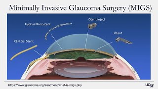 What is Glaucoma  What Causes Glaucoma Simple Answer [upl. by Amand]