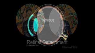 Retinal Detachment [upl. by Stutman]