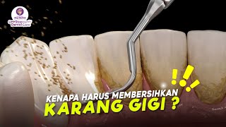 PENTINGNYA MEMBERSIHKAN KARANG GIGI [upl. by Pepi]