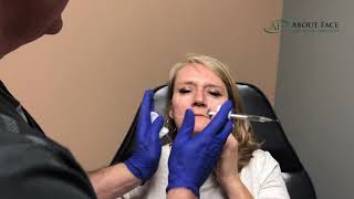 Juvederm Voluma Treatment Video [upl. by Reprah]