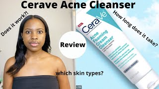 Watch This Before You Buy Cerave Acne Foaming Cream Cleanser Review⎜On Oily Acne prone Skin [upl. by Jezrdna820]