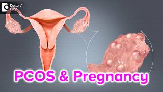 What happens if I have PCOS and I get pregnant  Dr Bala R [upl. by Stacey633]