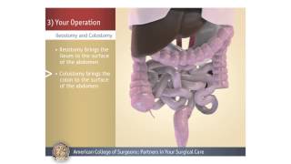 ColostomyIleostomy Your Operation [upl. by Bevash]