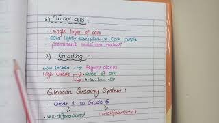 Prostate Carcinoma Pathology  Morphology and Gleason Grading [upl. by Mozes]