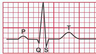 Normal EKG vs Heart Attack [upl. by Wilda]