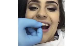 Veja como é a colocação de lentes de contato nos dentes [upl. by Adlaremse]